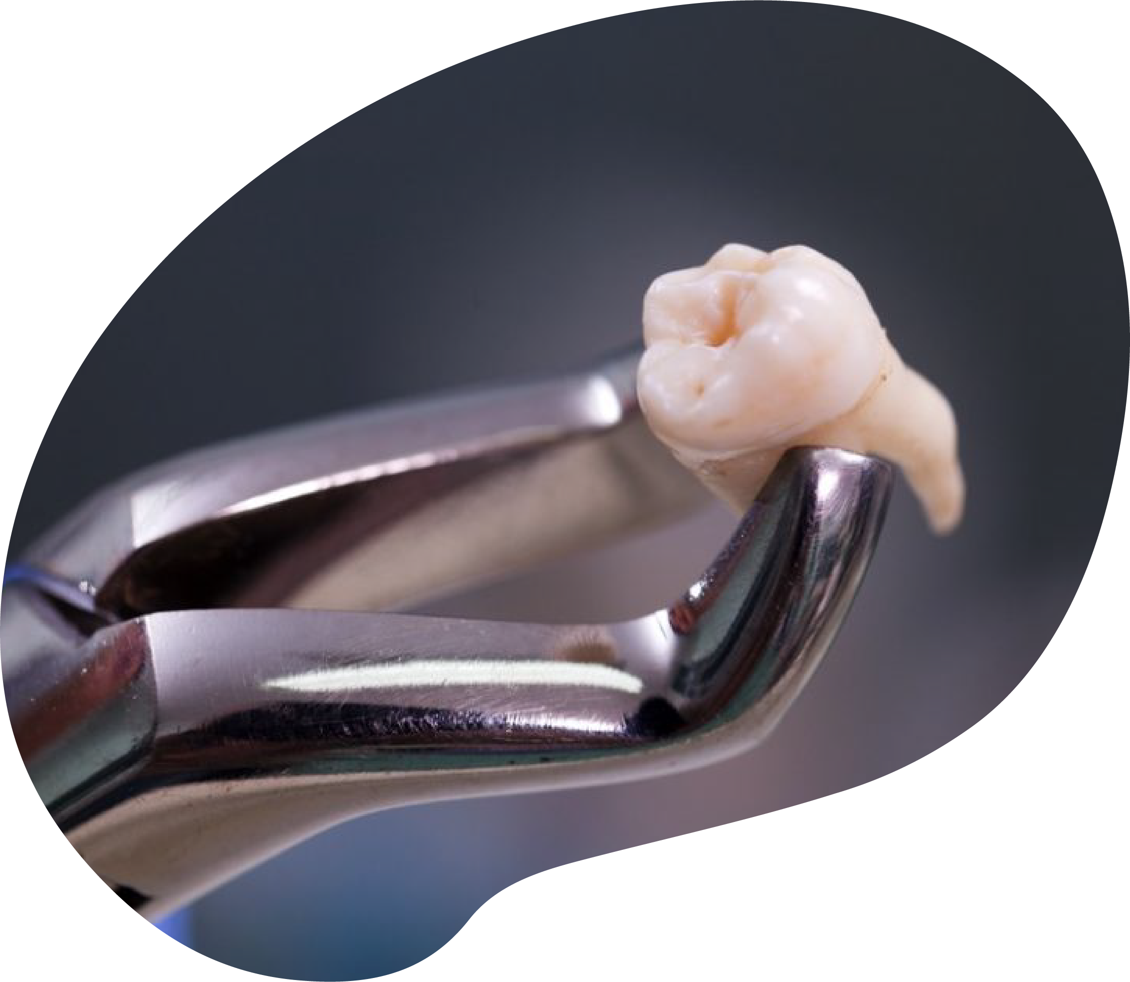 https://rancheritodental.com/wp-content/uploads/2024/07/TOOTH-Extractions.png