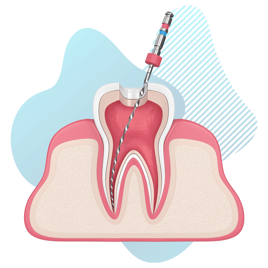 https://rancheritodental.com/wp-content/uploads/2024/07/root-canal.png